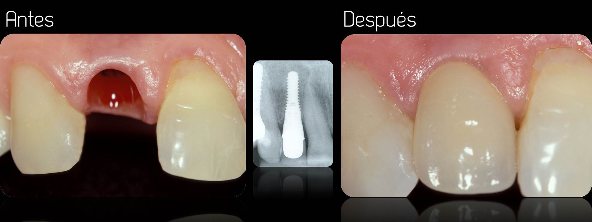 Resultado de imagen de implantes dentales