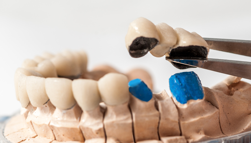 Qué son los puentes dentales qué tipos hay e indicaciones Estudi