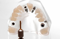 implantes-dentales-barcelona