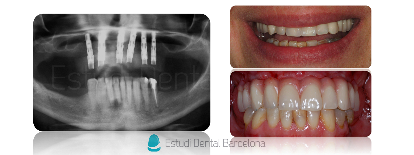 Implantes-Dentales-Barcelona-Prótesis-Híbrida-EDB