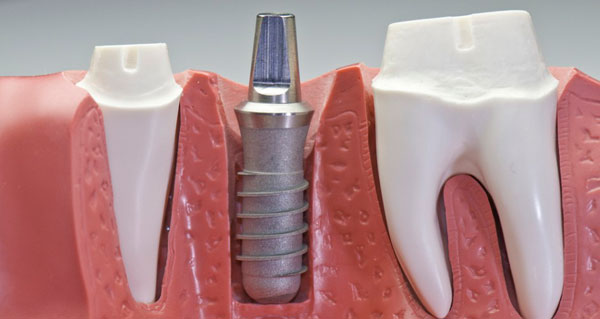implantes_dentales_first