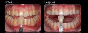 Dientes blancos con Blanqueamiento dental en Barcelona