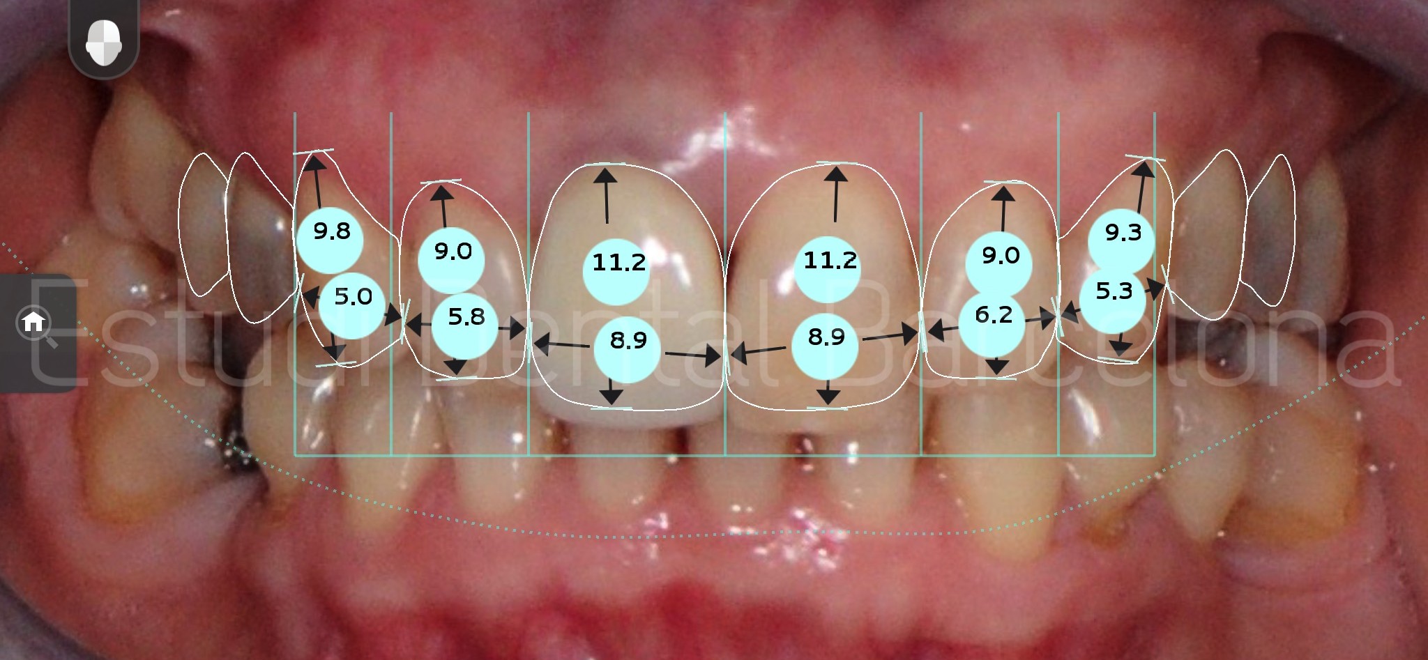 Digital Smile Design Barcelona