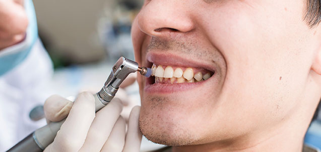 Fases de una limpieza dental