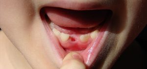 Soluciones a la pérdida de un diente en un niño