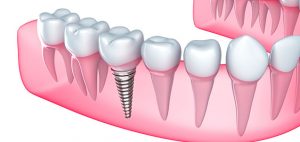 Tipos de implantes dentales