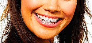 ¿Qué son los brackets autoligables?