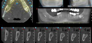 Uso de Tomografías computarizadas (TAC) en el estudio de implantes dentales y dientes