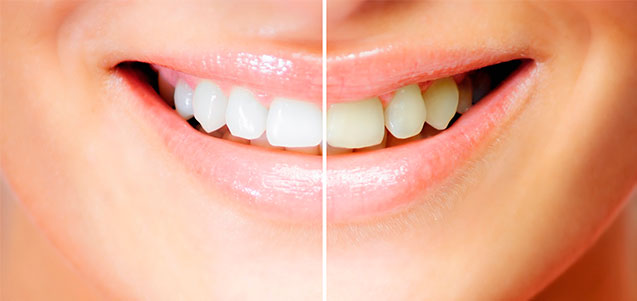Carillas dentales. Tipos y materiales utilizados