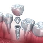 Implante dental con prótesis - Barcelona