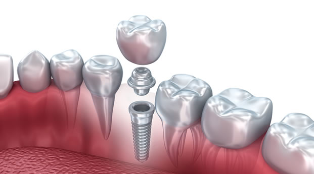 Implante dental con prótesis - Barcelona