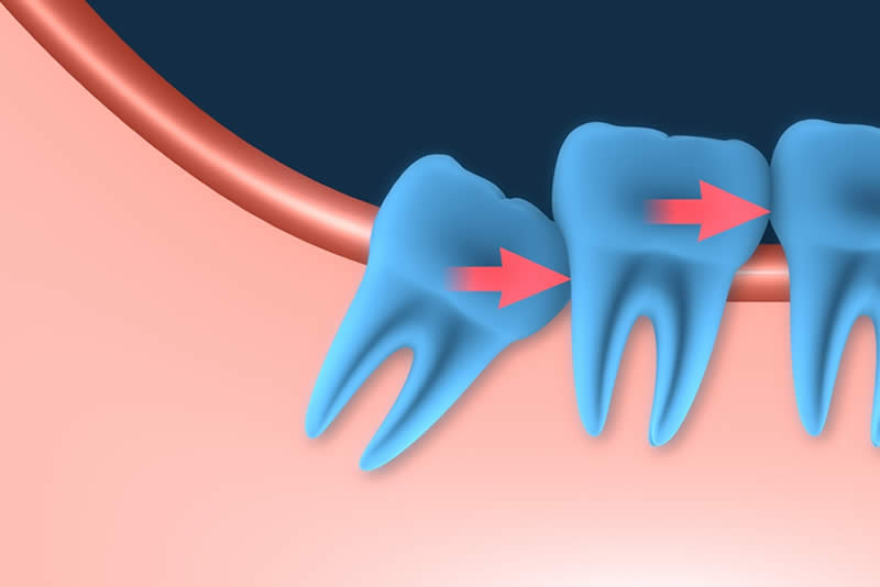 Ortodoncia para dientes incluidos Barcelona