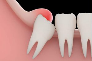 ortodoncia diente incluido Barcelona