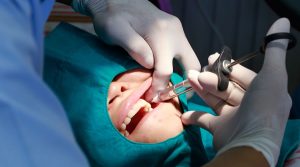 Cirugia dental quiste radicular