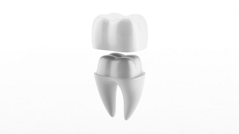 Tipos De Coronas (fundas) Dentales – Estudi Dental Barcelona