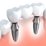 ejemplo de implante dental