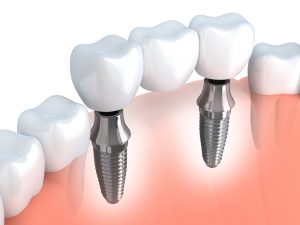 ejemplo de implante dental