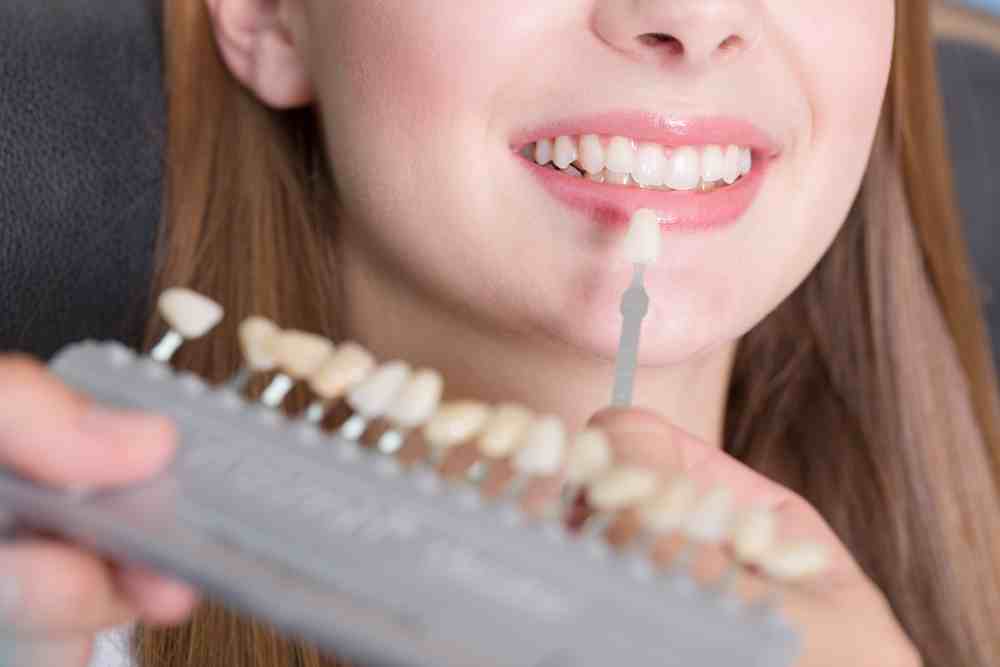 Mantenimiento de las carillas dentales