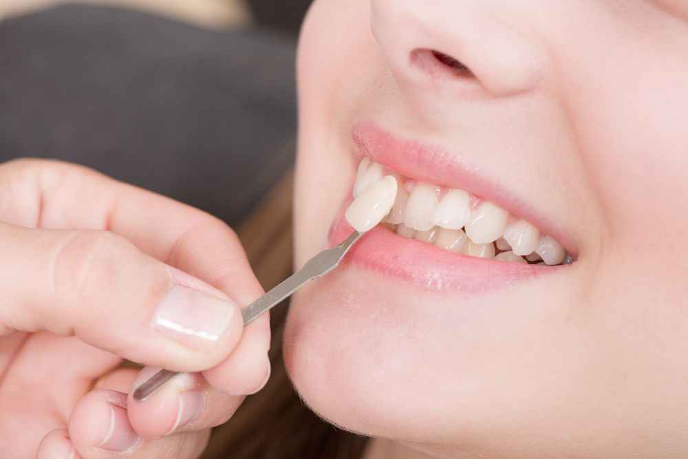 Carillas dentales: Tipos y cuándo usarlas