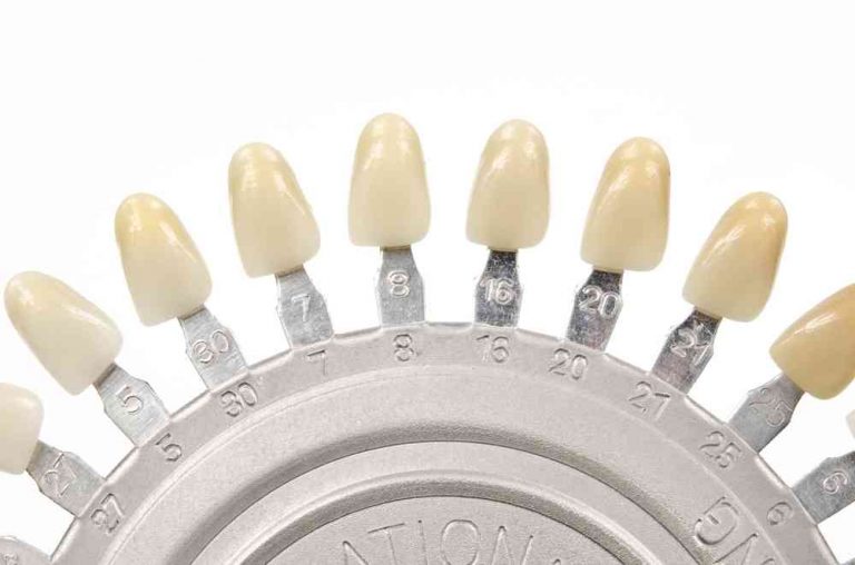 ¿Qué Tipos De Carillas Dentales Existen? Composite Vs Porcelana ...