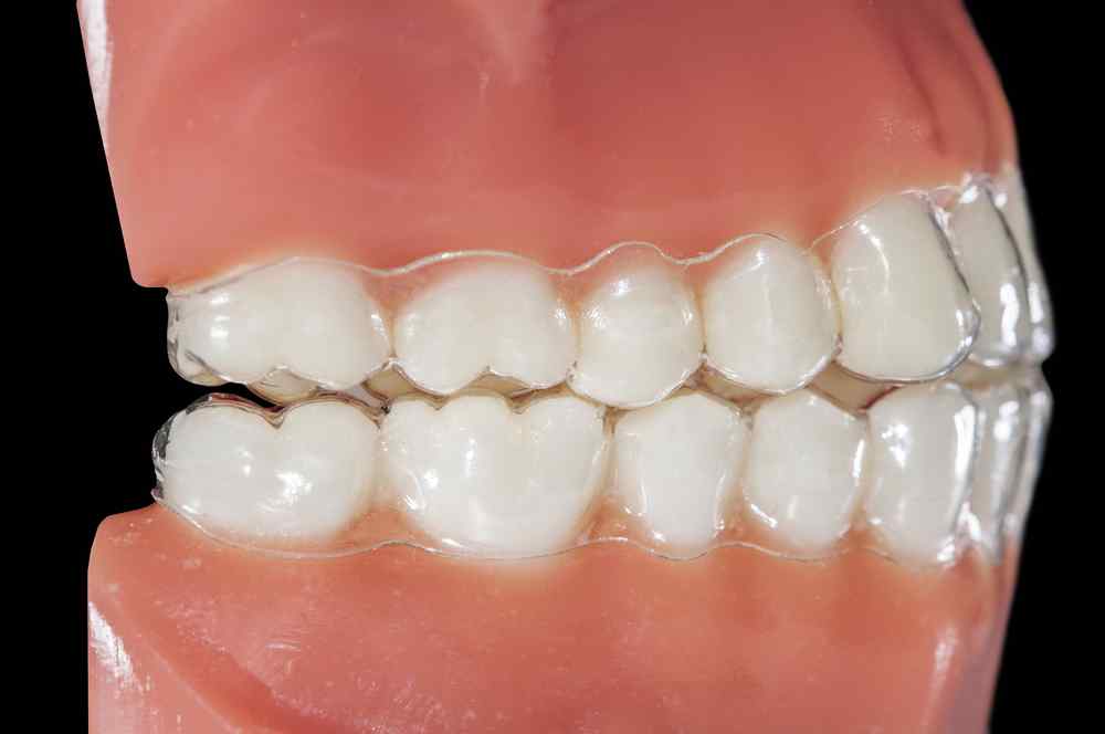 Bruxismo dental: causas, desencadentantes, síntomas y tratamiento