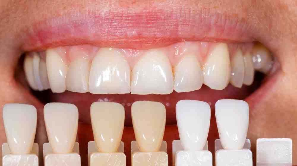 Para qué sirven las carillas dentales? Indicaciones y ventajas – Estudi  Dental Barcelona