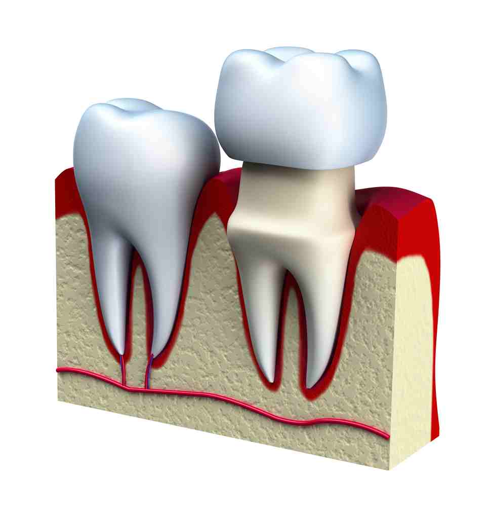 Zirconio o metal en coronas sobre implantes? – Estudi Dental Barcelona
