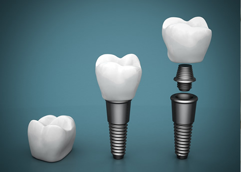 Implantes dentales: Duran toda la vida?