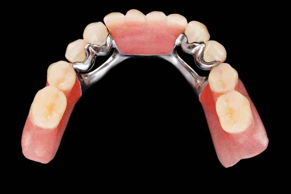 Indicaciones puente dental para edéntulo | ED
