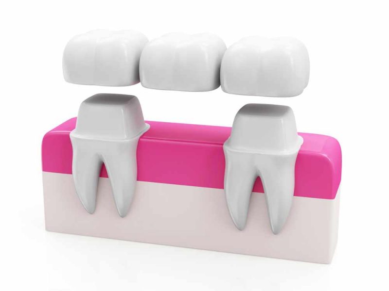 ¿Qué es un puente dental? Tipos