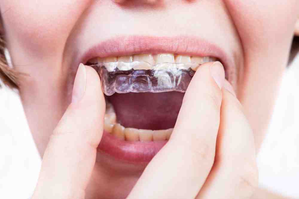 Cuándo y cómo se debe mejorar una férula de descarga? – Estudi Dental  Barcelona