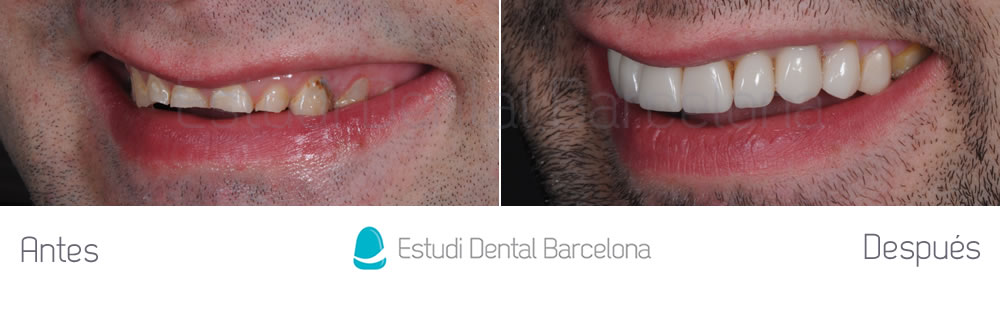 Carillas dentales en Barcelona y Manresa