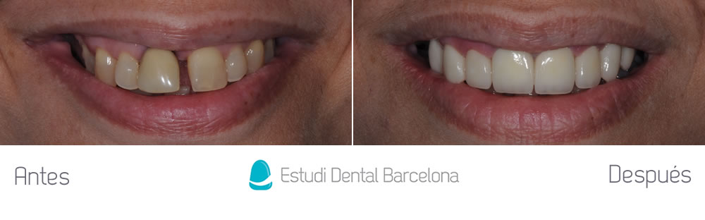 Diastema y corona vieja - caso clinico carillas dental - frente