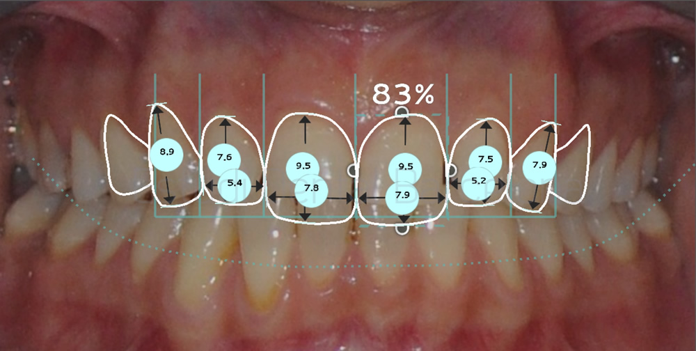 espacios-abiertos-entre-dientes-carillas-dentales-antes-y-despues-proporciones