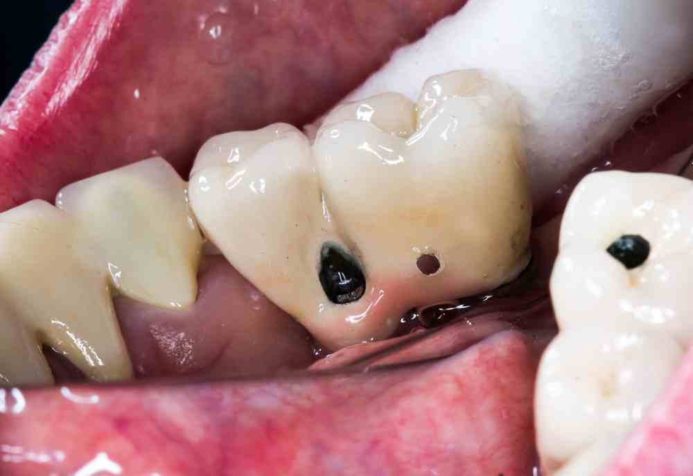 Zirconio o metal en coronas sobre implantes? – Estudi Dental Barcelona