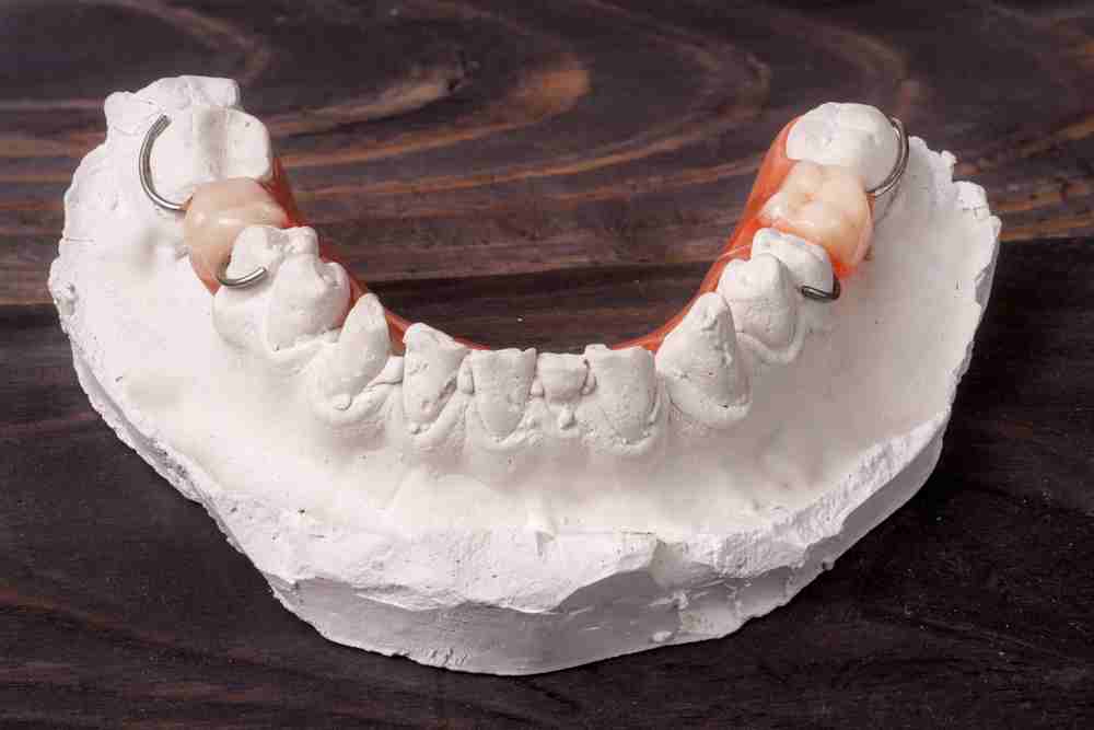 Qué son y para qué sirven las impresiones dentales? – Estudi Dental  Barcelona