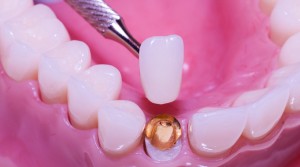 Diferencias entre las coronas de zirconio y de 100% porcelana – Estudi