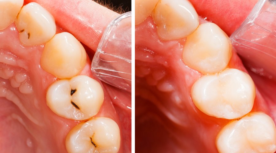 Ventajas y desventajas de los empastes de resina – Estudi Dental Barcelona