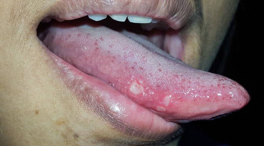 Estoy orgulloso bomba repollo En qué consisten las llagas en la lengua y cómo curarlas? – Estudi Dental  Barcelona