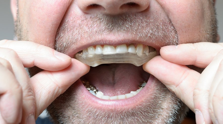 Parpadeo preocupación bala Protector bucal para el bruxismo: ¿en qué consiste? – Estudi Dental  Barcelona