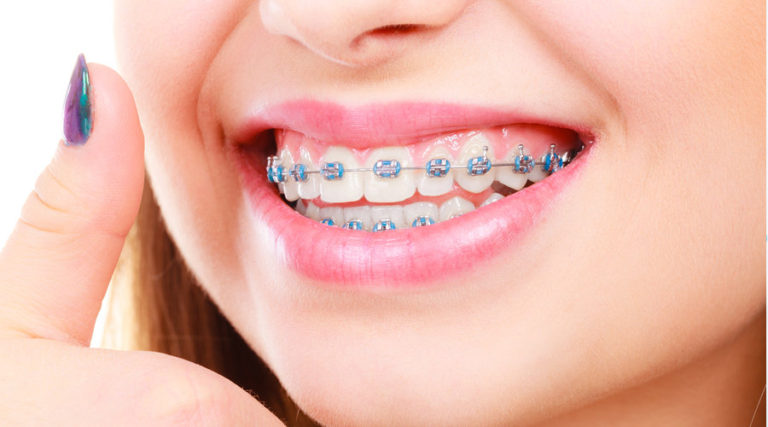 Consejos Y Cuidados De La Ortodoncia Con Brackets – Estudi Dental Barcelona