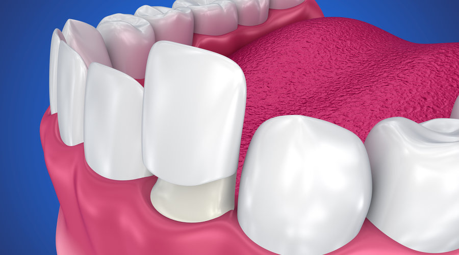Qué son las carillas dentales? Ventajas y desventajas