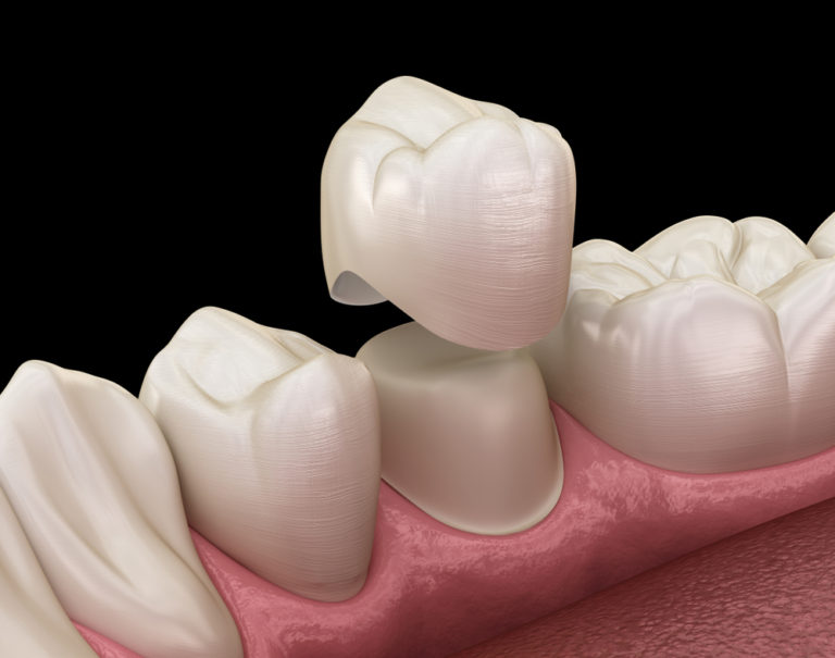 Coronas dentales de porcelana, tipos e indicaciones – Estudi Dental