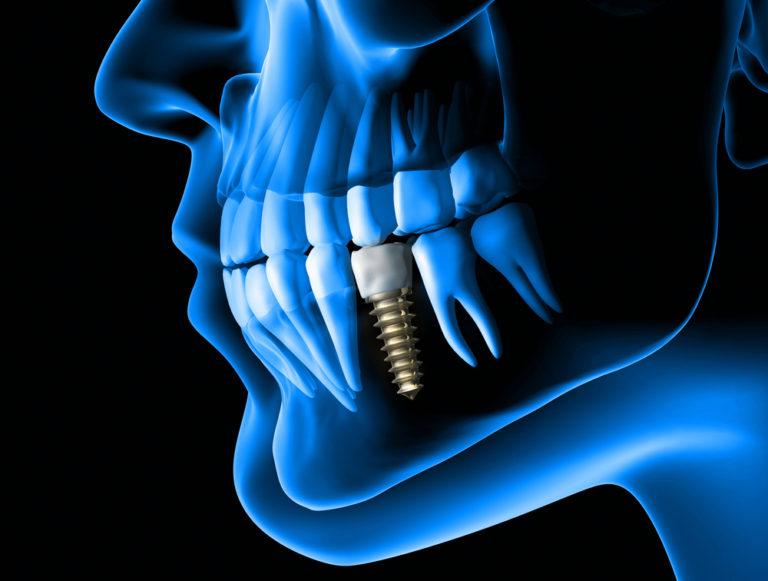 Qu Es La Osteointegraci N De Los Implantes Dentales Estudi Dental Barcelona