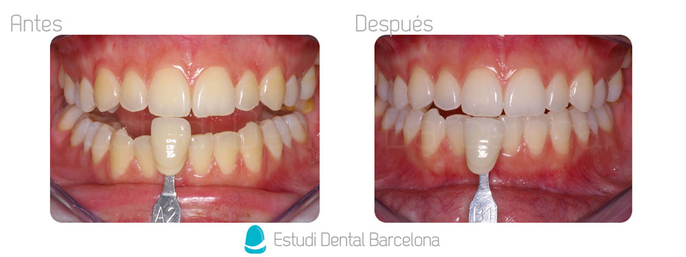 Blanqueamiento dental Barcelona