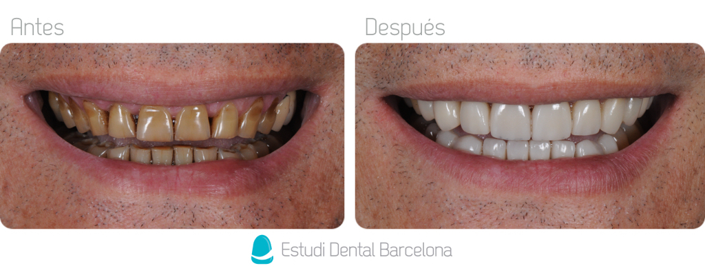 tratamiento estética dental en barcelona