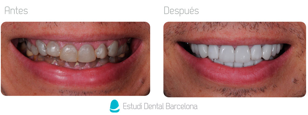 Carillas dentales en Barcelona
