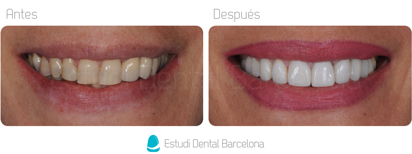 Coronas Dentales Barcelona Dientes Blancos