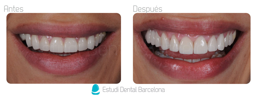 Diferencias entre las coronas de zirconio y de 100% porcelana – Estudi  Dental Barcelona