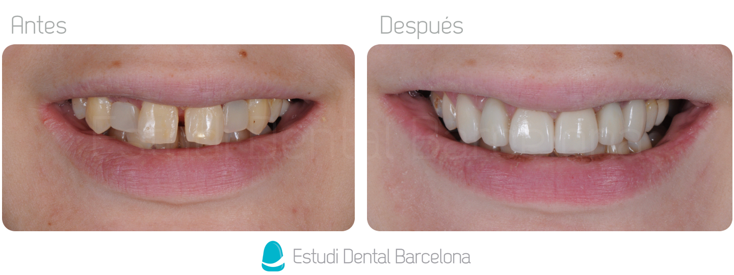 Coronas Dentales Zirconio Barcelona